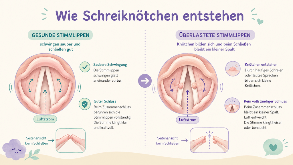 Infografik zeigt, wie an überlasteten Stimmlippen Knötchen entstehen und die Stimme heiser machen (KI-generiert)